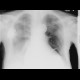 Fluidothorax, supine radiograph: X-ray - Plain radiograph